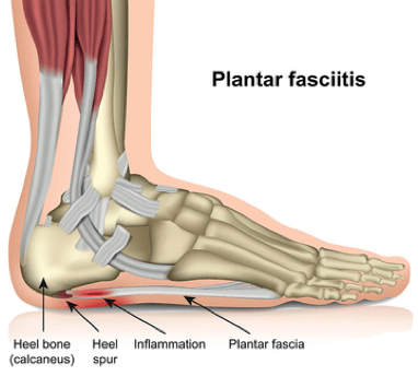 plantar fasciitis - cause of heel pain